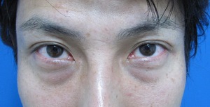 目の下のたるみ、目のくまでお悩みの方、切らずに完璧に解決します。TCB-R法　手術直後　症例写真